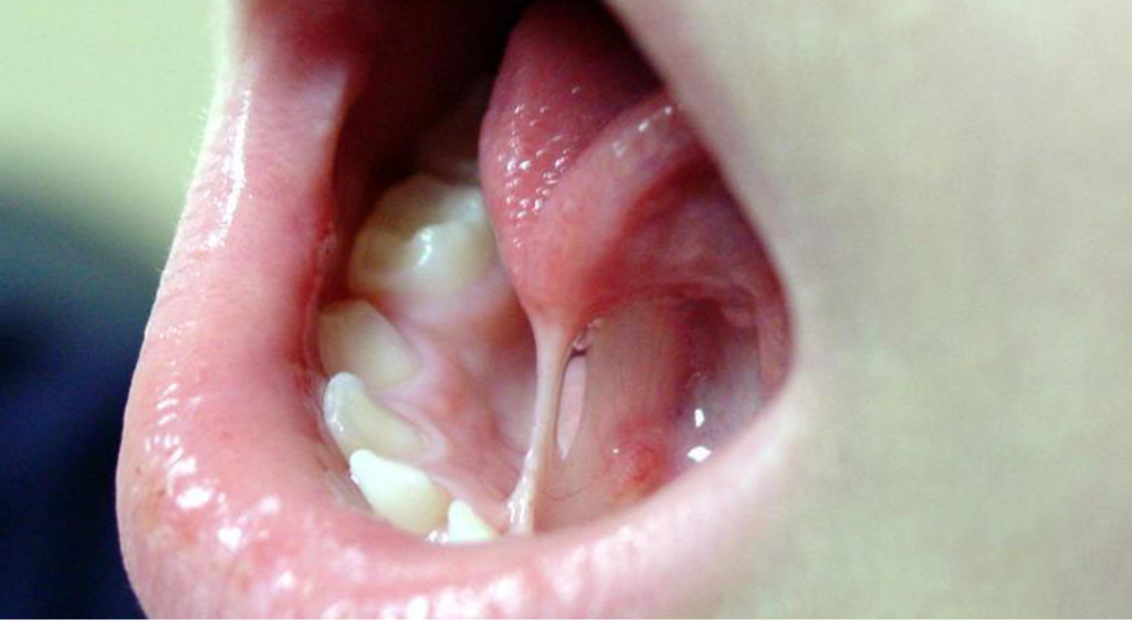 what-does-tongue-tie-look-like-tongue-tie-lip-tie-laser-frenectomy